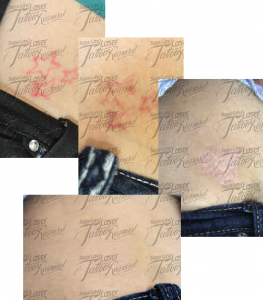 ... laser tattoo removal before and after pictures of 3 pink stars tattoo