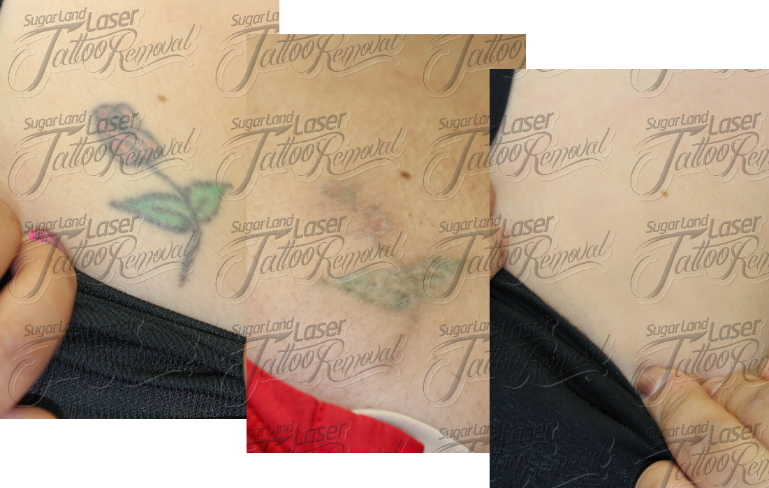 laser tattoo removal work skin deep skin sweet the quality of a tattoo ...