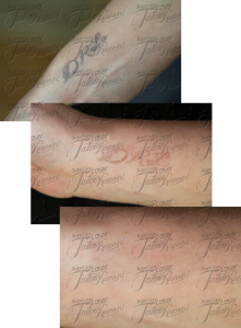Laser Tattoo Removal with nd-yag laser