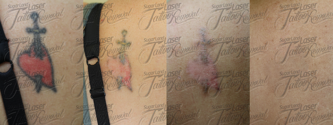 ... tattoo removal 1st session tattoo removal 3rd session tattoo removal