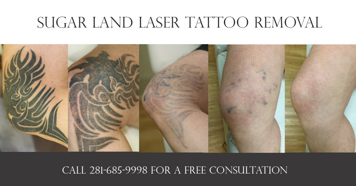 28+ [ Sugar Land Laser Tattoo Removal ] | Picosure Tattoo ...